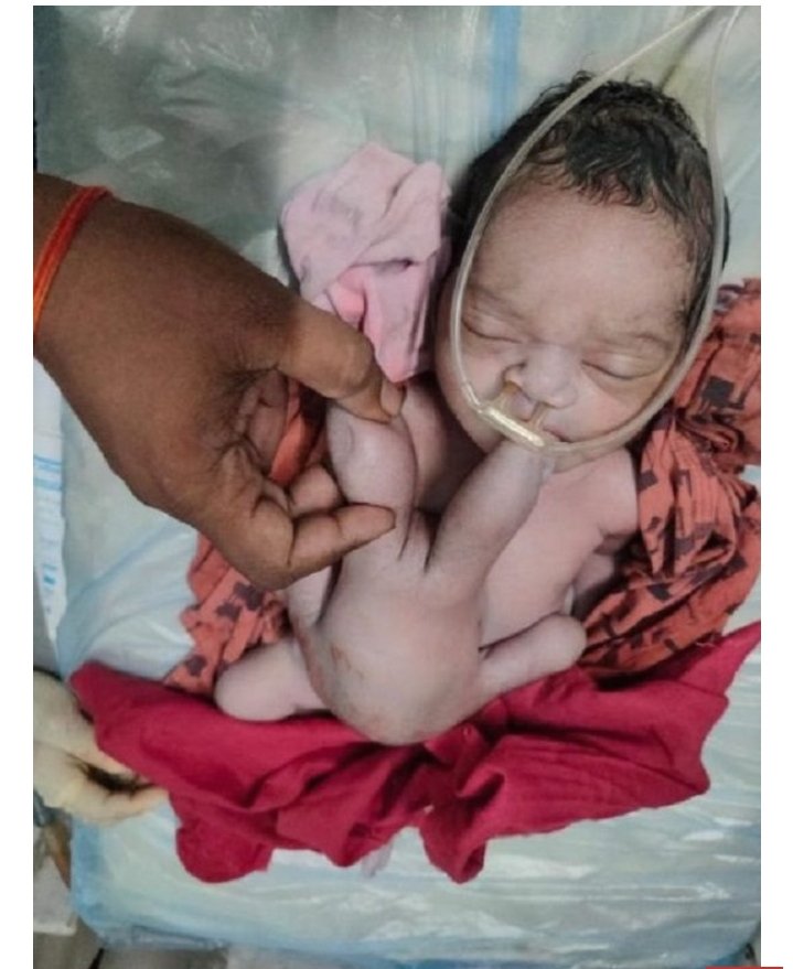 Le bébé de Kareena, une Indienne n'ait avec plus de 3 Kilogrammes. Il dispose de 4 bras et de 4 Jambes.