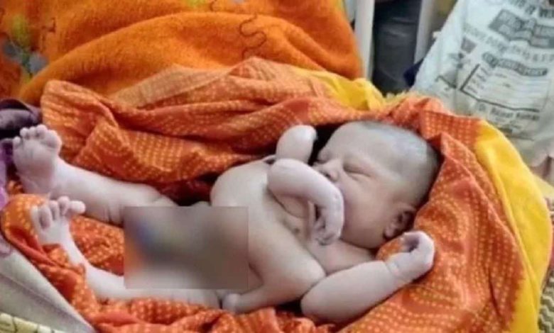Un bébé naît avec 4 paires de bras et jambes en Inde