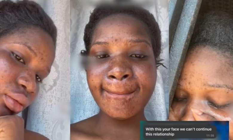 Elle se fait larguer par son petit ami après avoir utilisé des produits éclaircissant qui ont endommagé l'état de son visage.